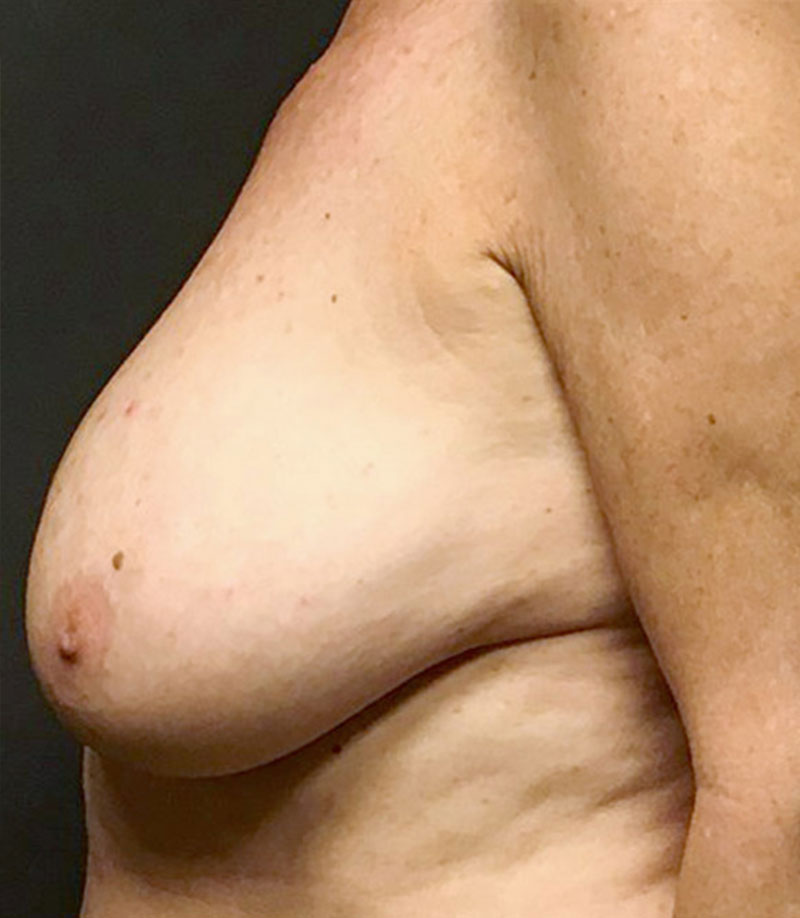 Inverted Nipple Repair 03