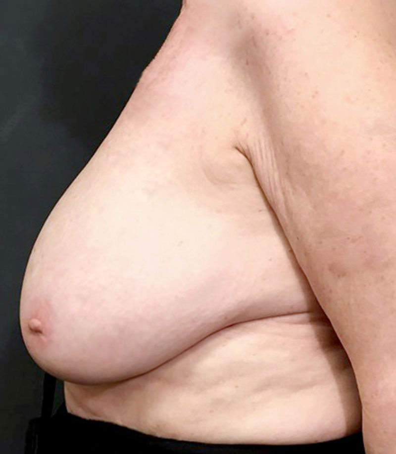 Inverted Nipple Repair 03