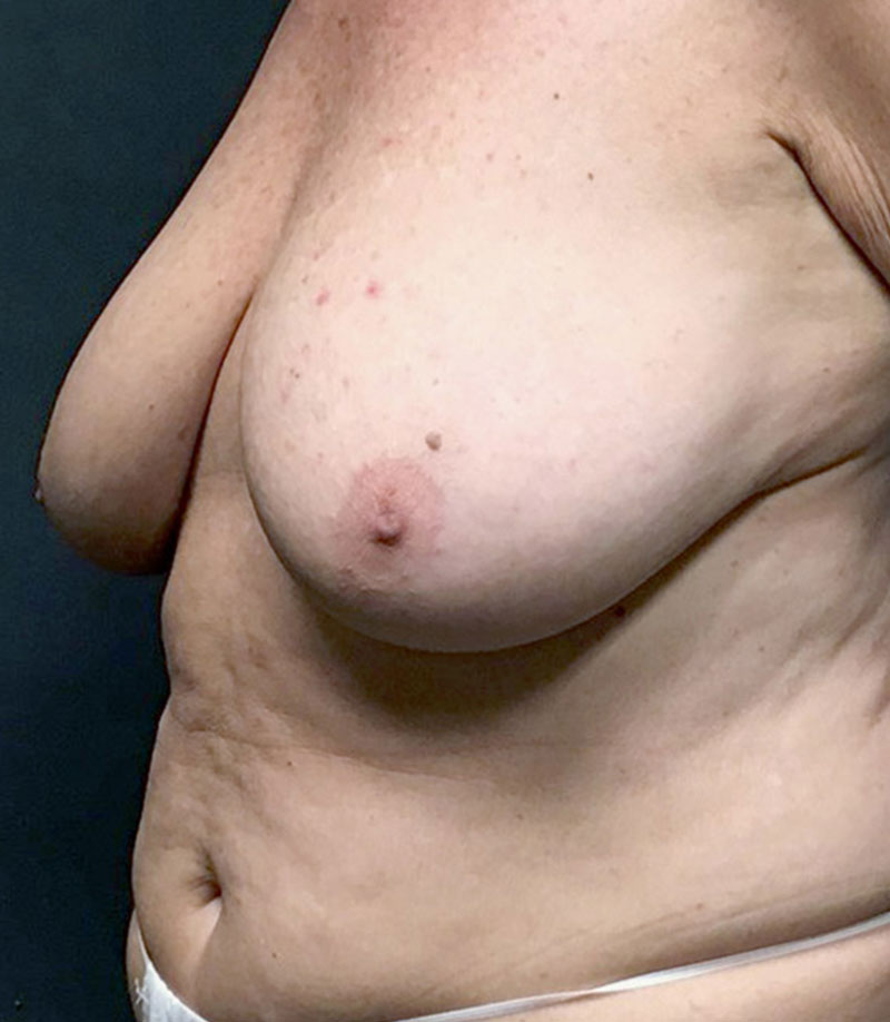 Inverted Nipple Repair 05