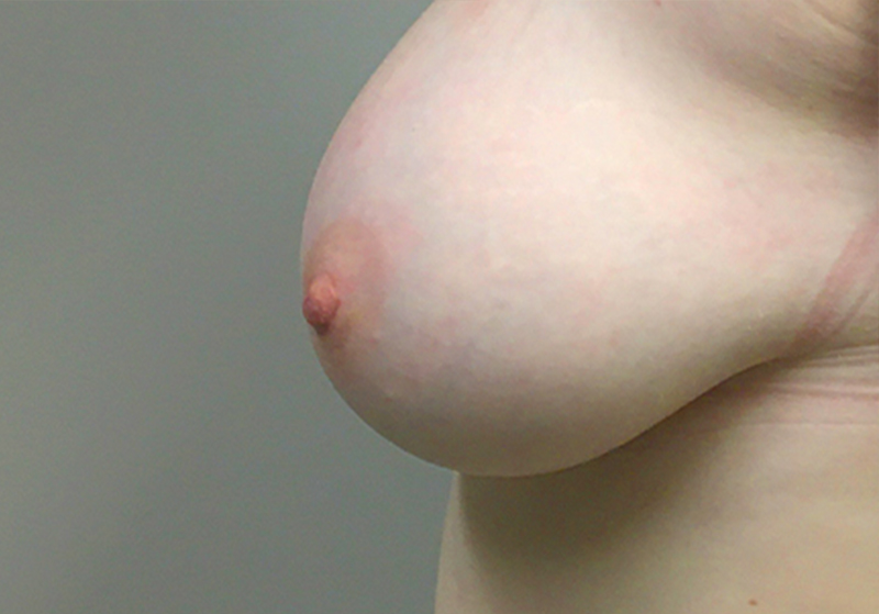 Inverted Nipple Repair 05