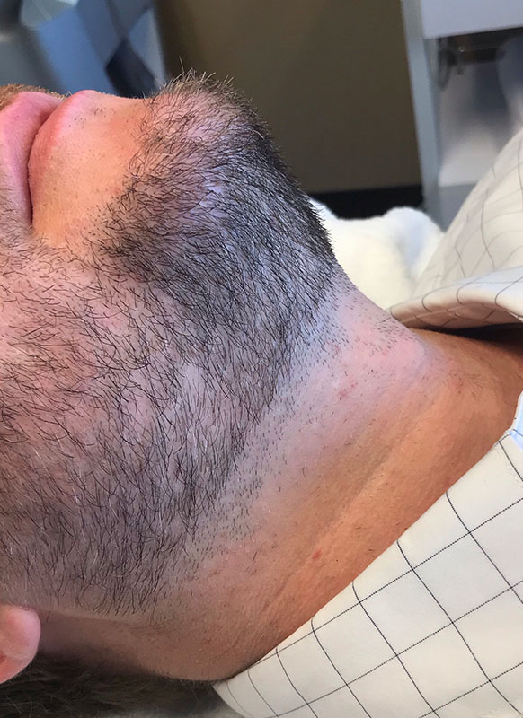 Laser Hair Removal 01