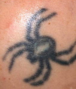 Laser Tattoo Removal 01