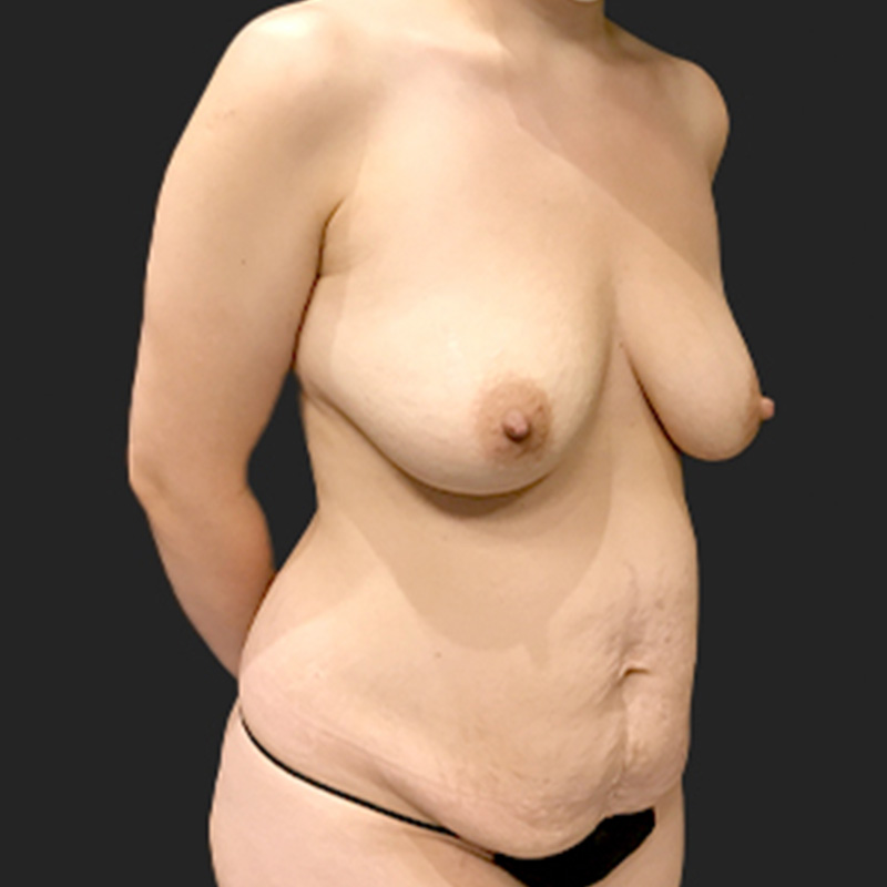 Liposuction Abdomen 03