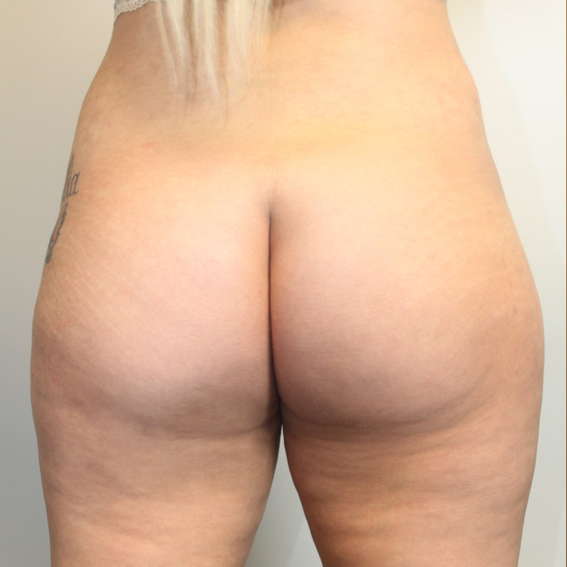Liposuction Abdomen 09