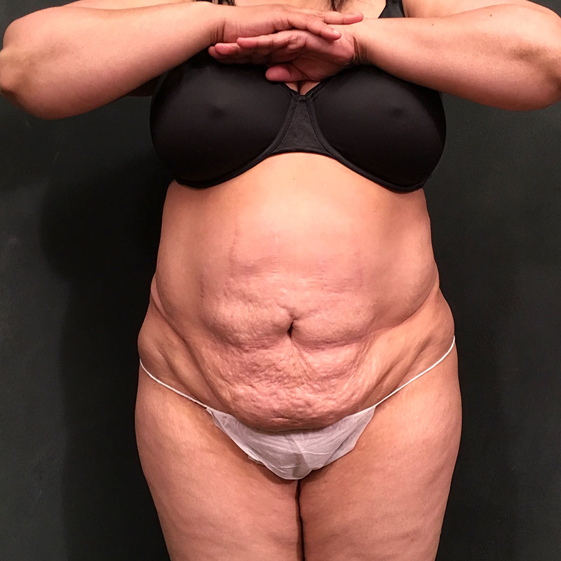 Liposuction Abdomen 01