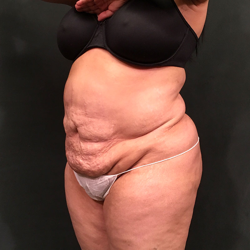 Liposuction Abdomen 03