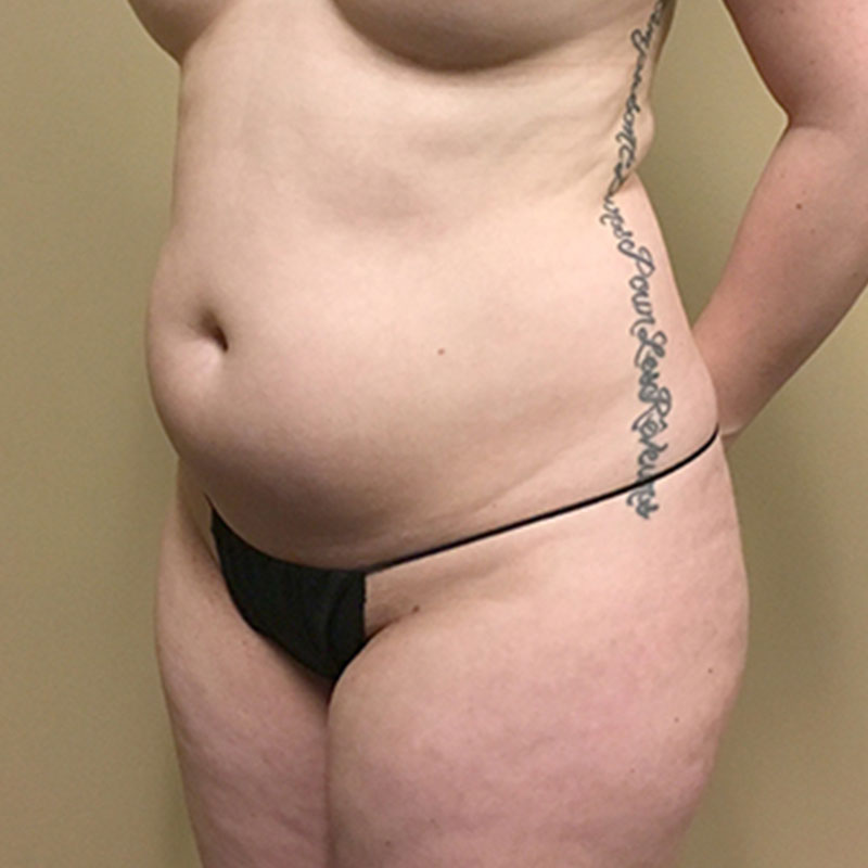 Liposuction Abdomen 03