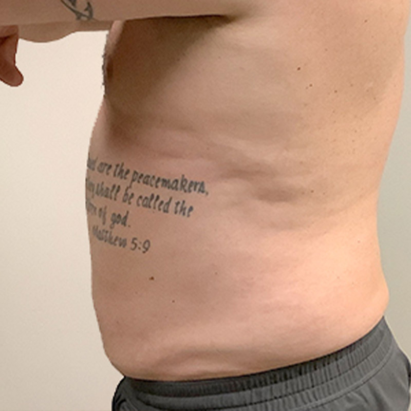 Liposuction Abdomen 17