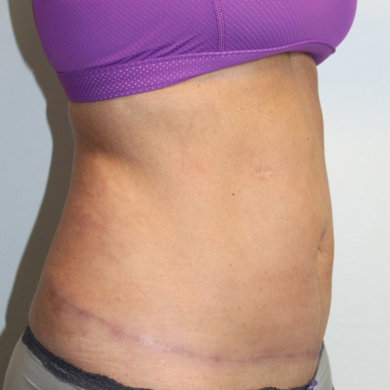 Liposuction Abdomen 03