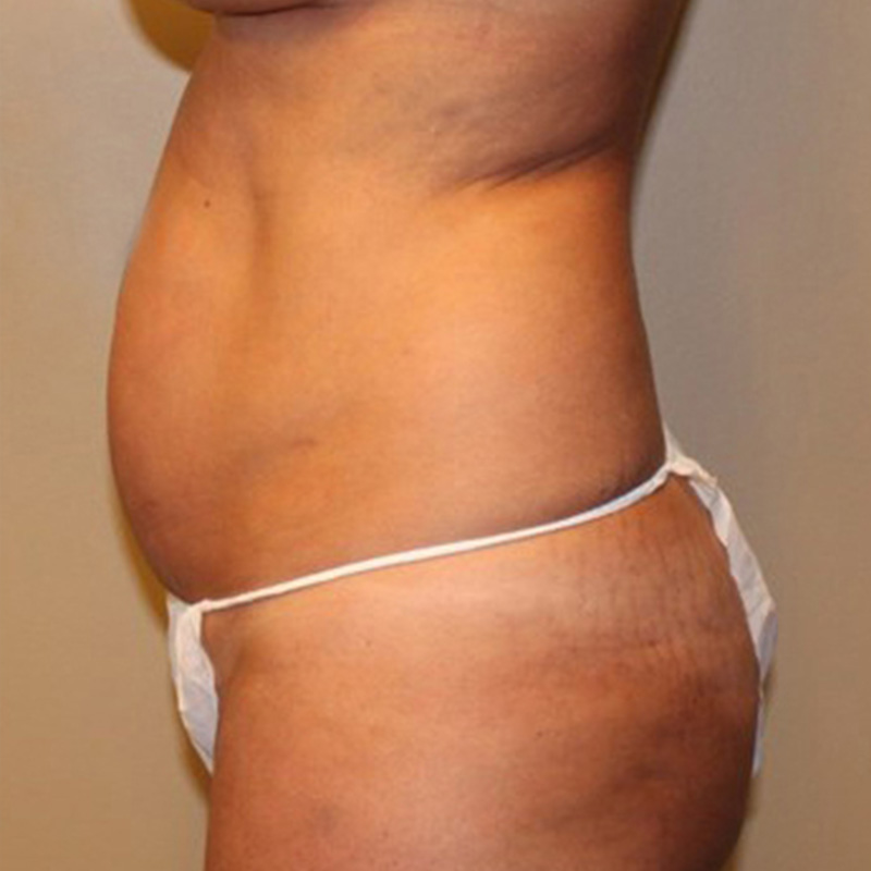 Liposuction Abdomen 09