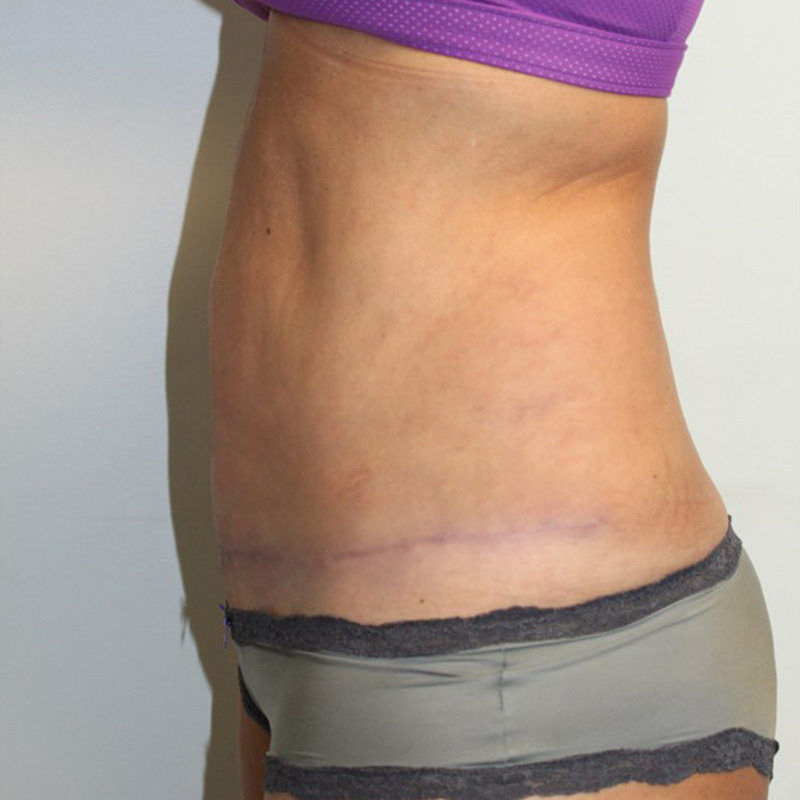 Liposuction Abdomen 09