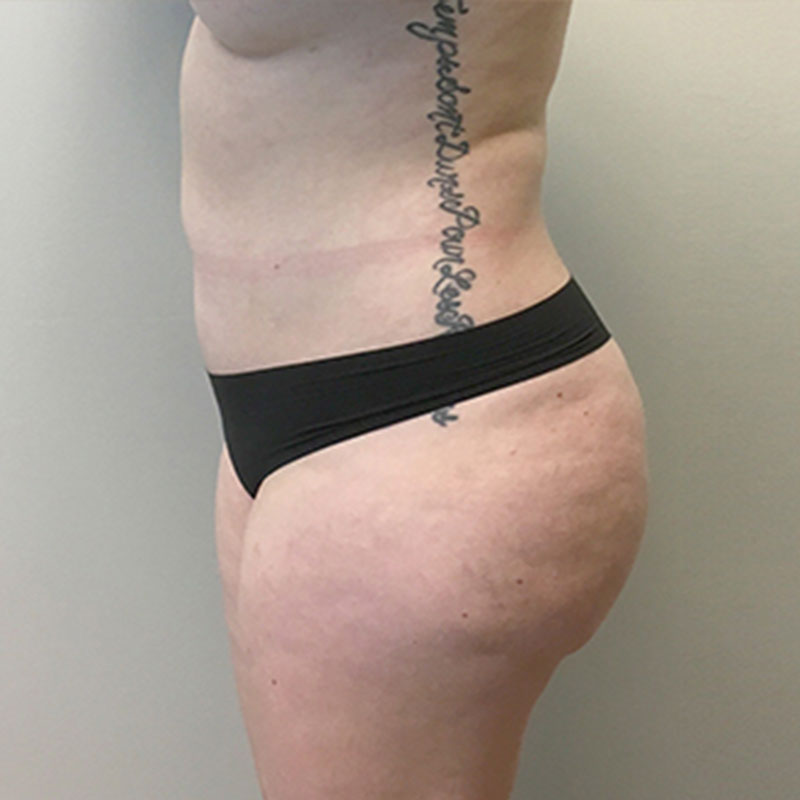 Liposuction Abdomen 03