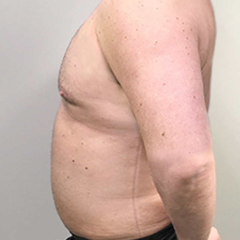 Liposuction Abdomen 05