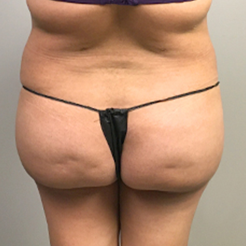 Liposuction Abdomen 27
