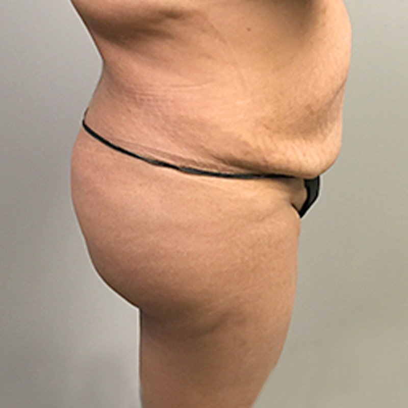 Liposuction Abdomen 09