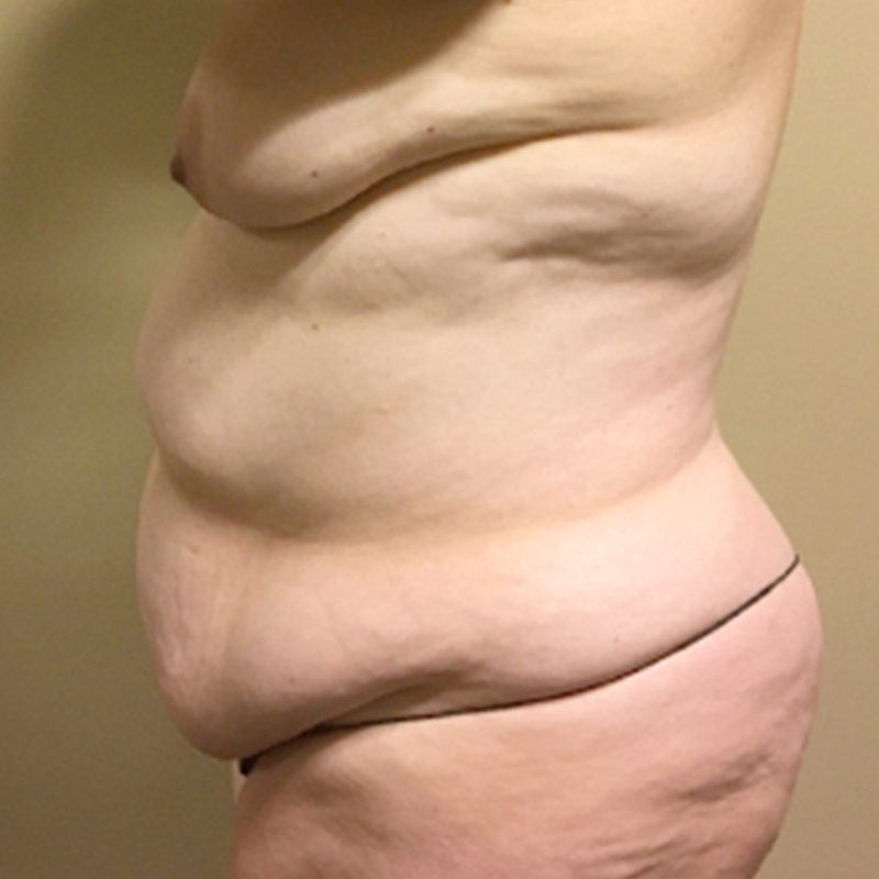 Liposuction Abdomen 03