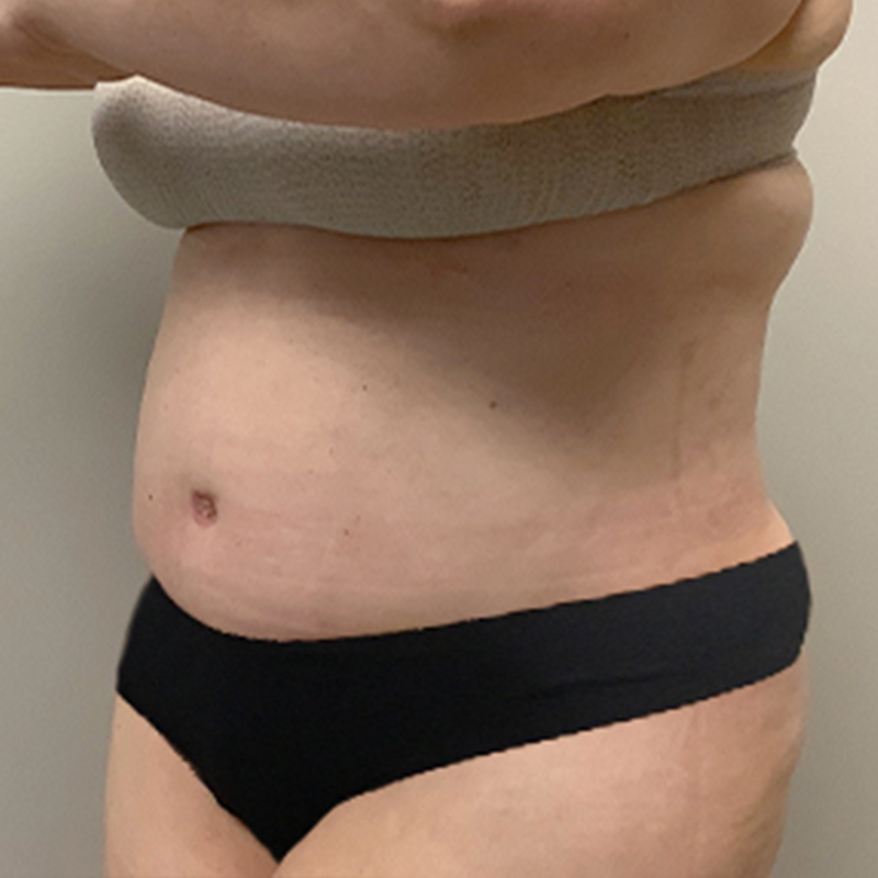 Liposuction Abdomen 05