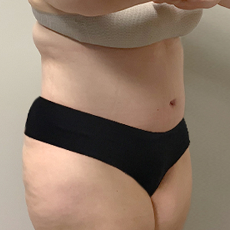 Liposuction Abdomen 07