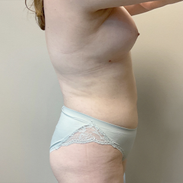 Liposuction Abdomen 09