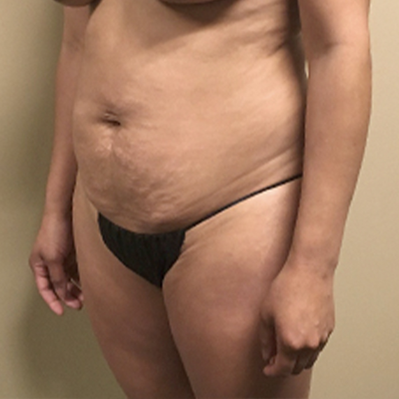 Liposuction Abdomen 05