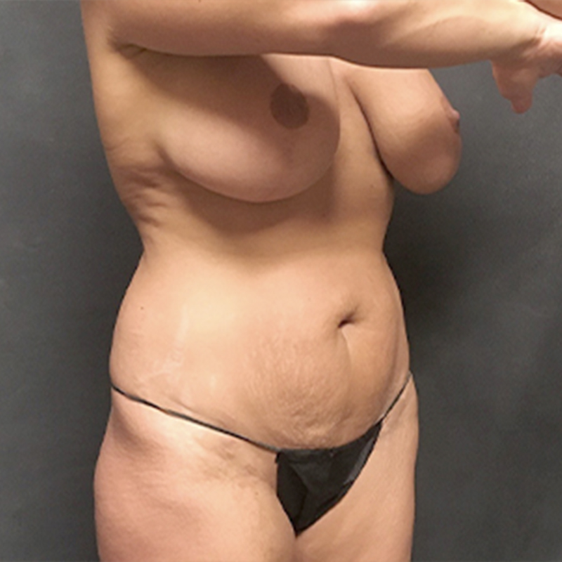 Liposuction Abdomen 15