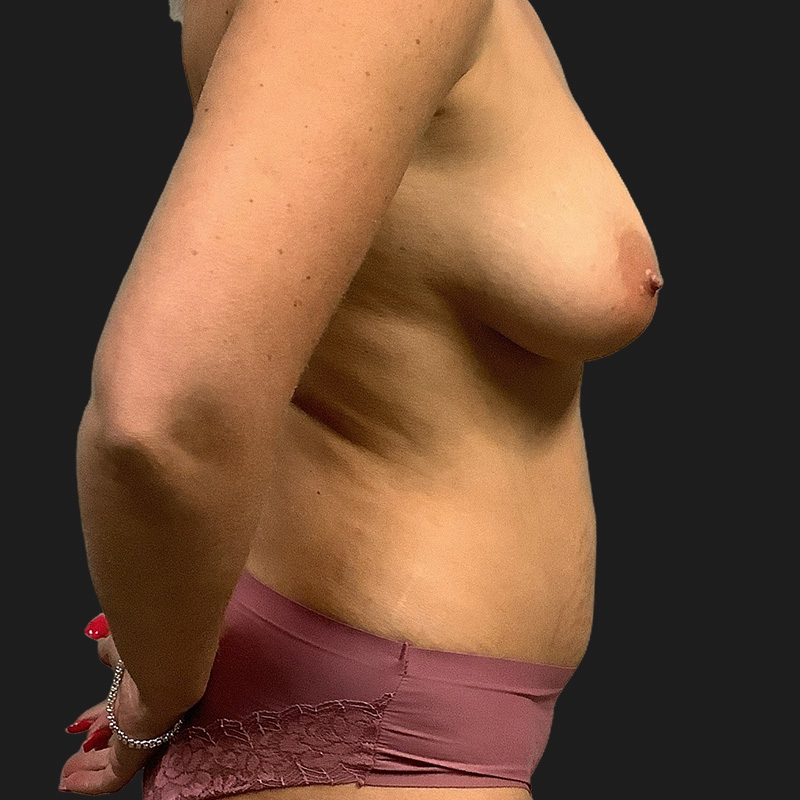 Liposuction Abdomen 05