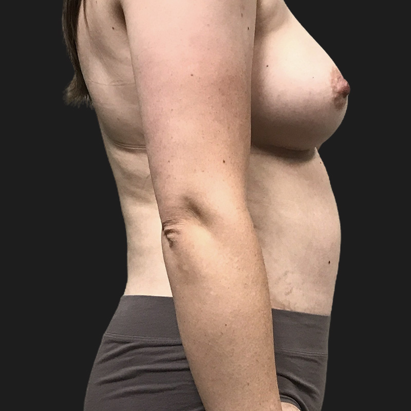 Liposuction Abdomen 03