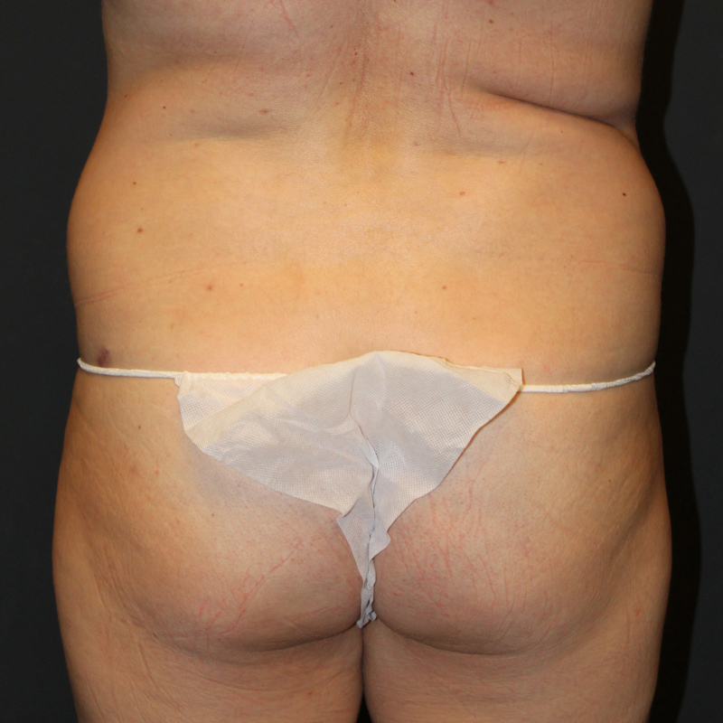 Liposuction Hips 01
