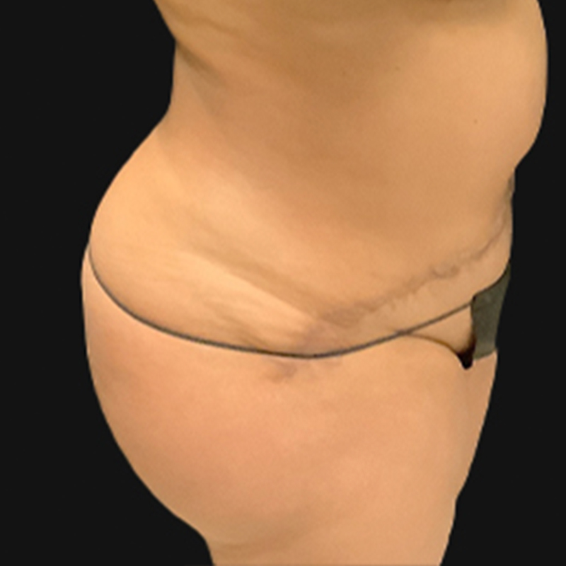 Liposuction Hips 05