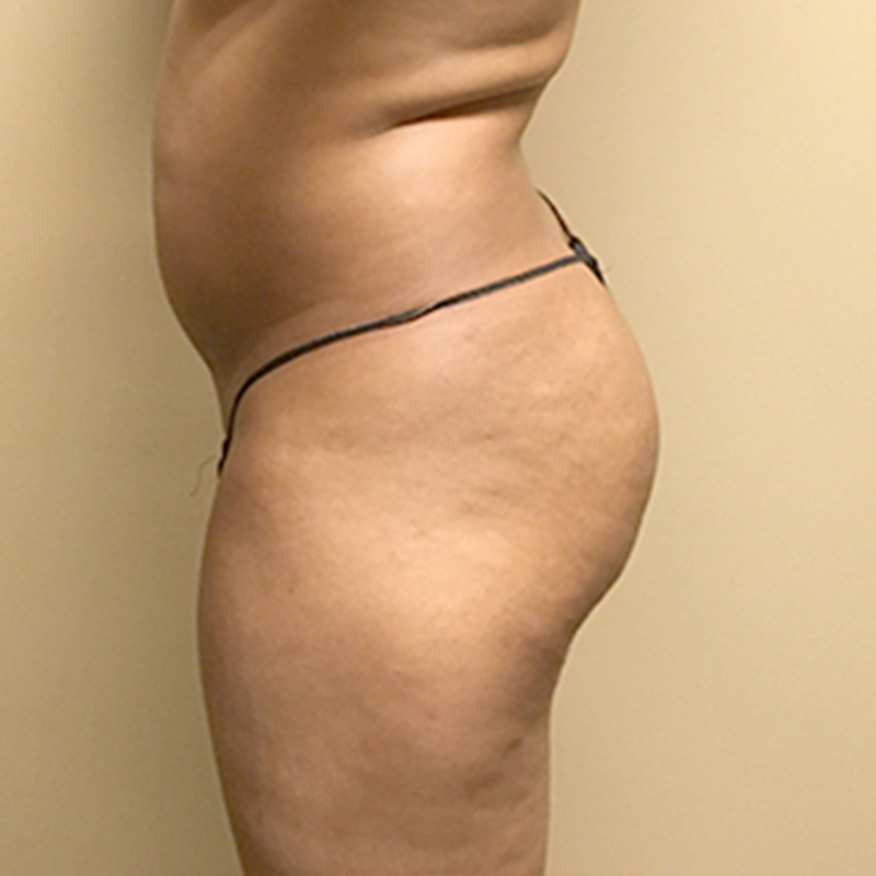 Liposuction Hips 05
