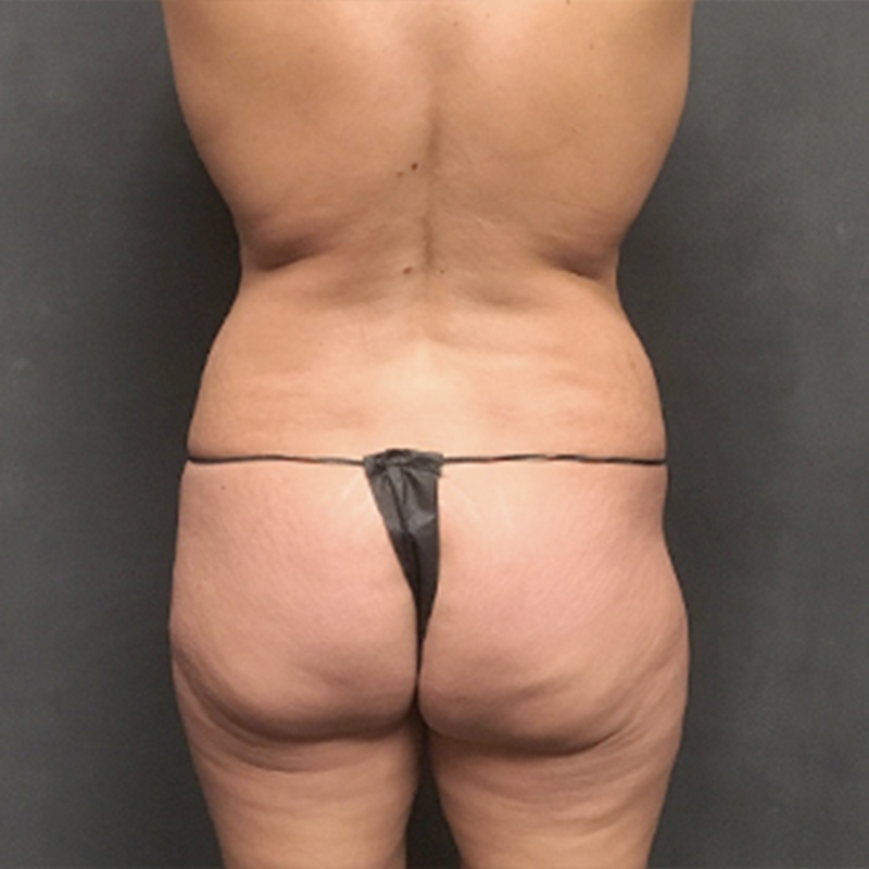 Liposuction Hips 01