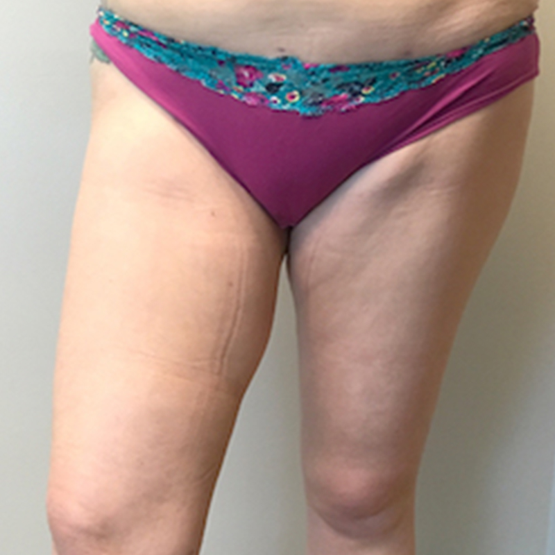 Liposuction Inner And Outer Thighs 02