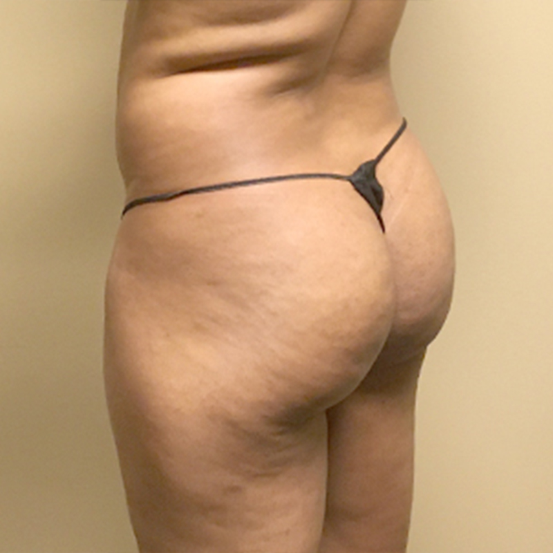 Liposuction Inner And Outer Thighs 03