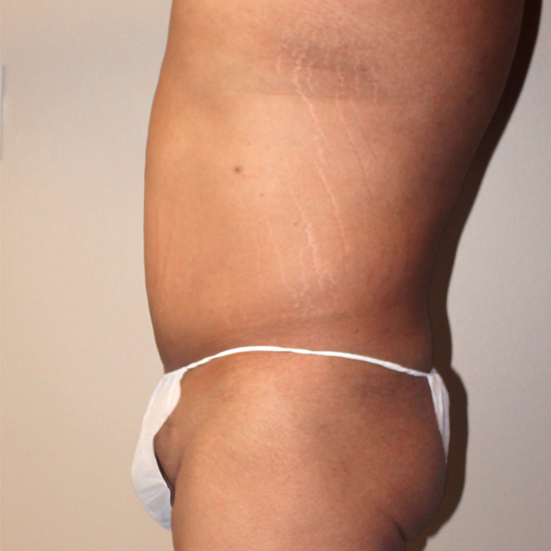Liposuction Lower Back 03