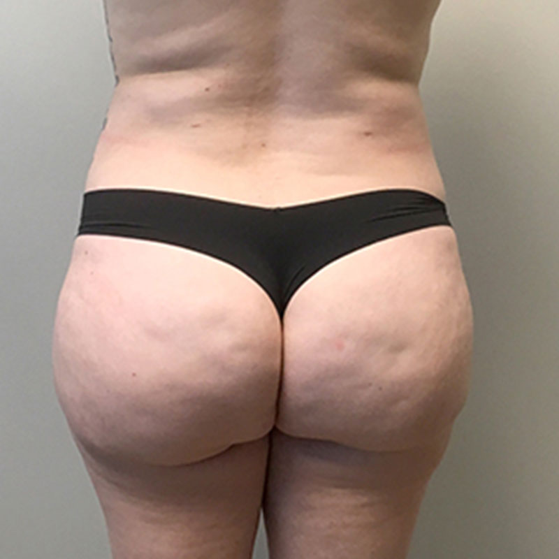 Liposuction Lower Back 07