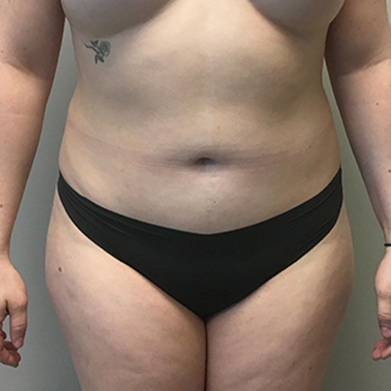 Liposuction Lower Back 03