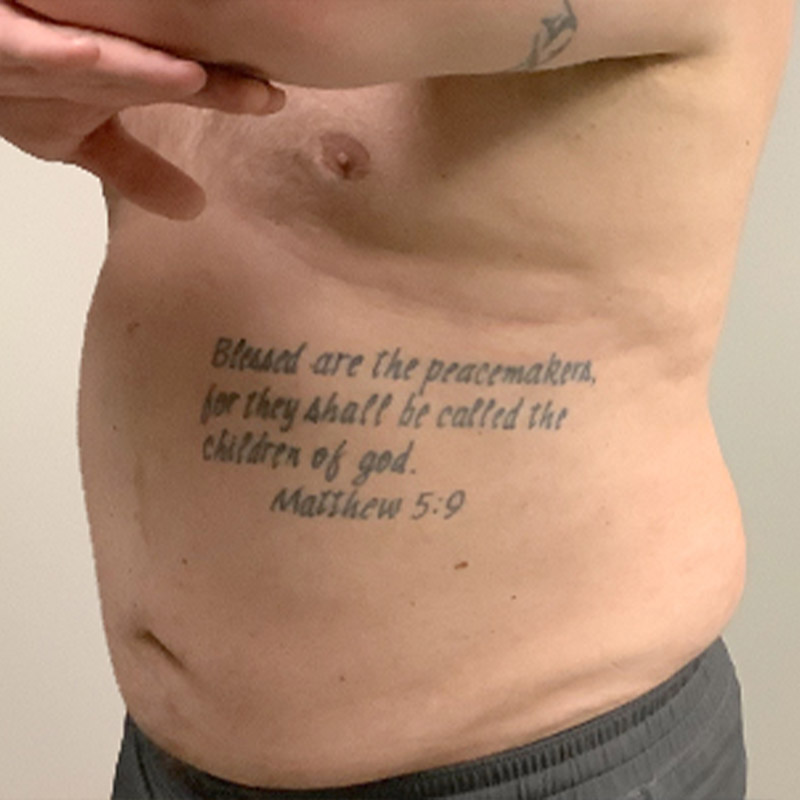 Liposuction Lower Back 05