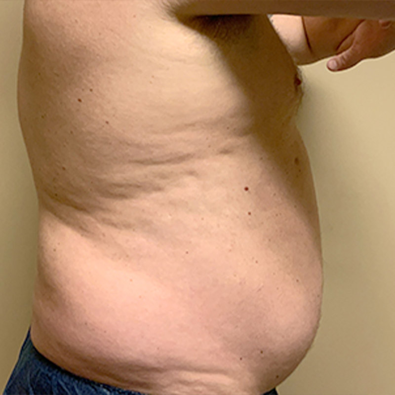 Liposuction Lower Back 07