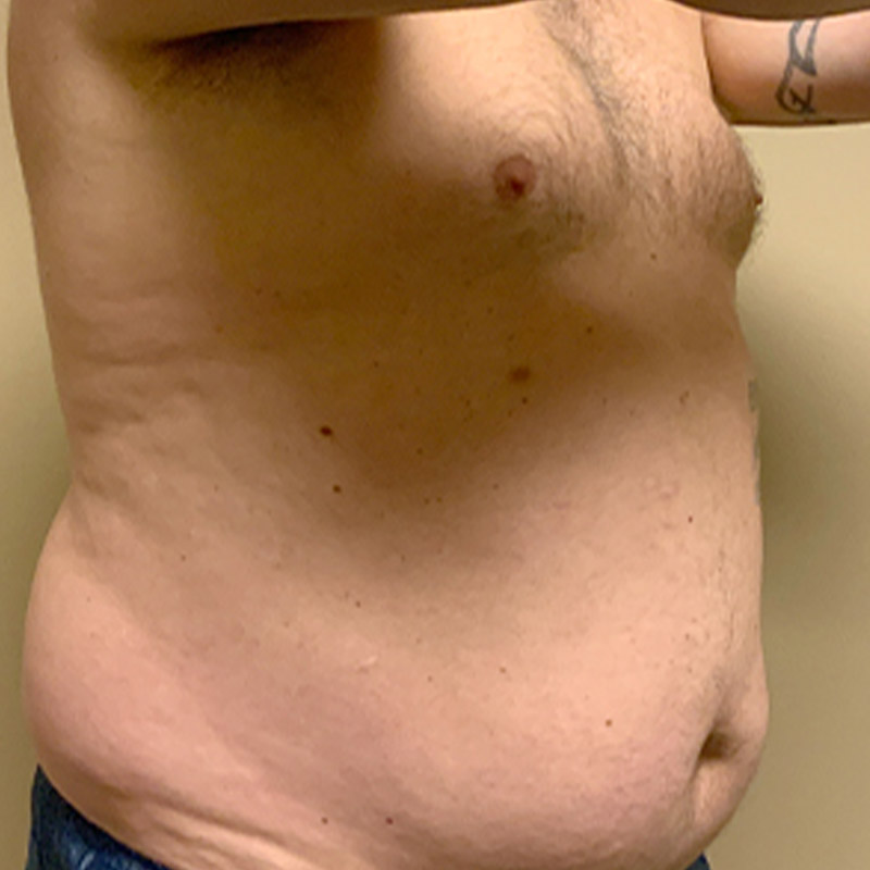 Liposuction Lower Back 09