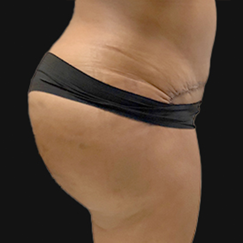 Liposuction Lower Back 05
