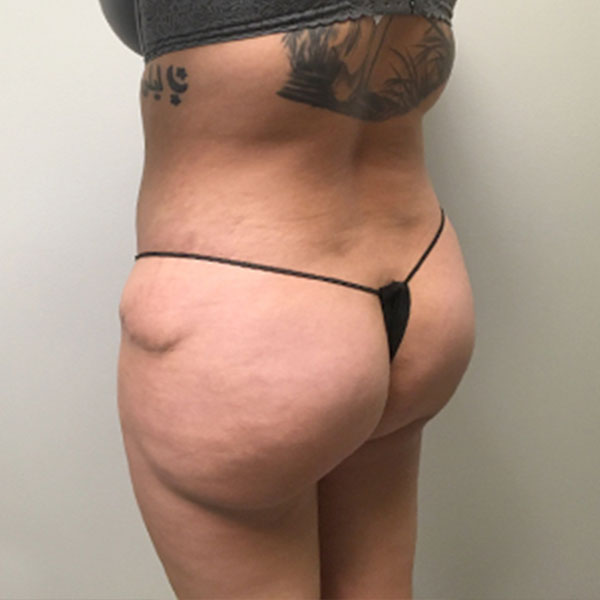 Liposuction Lower Back 13