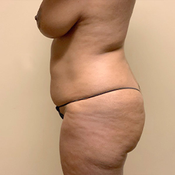 Liposuction Lower Back 03