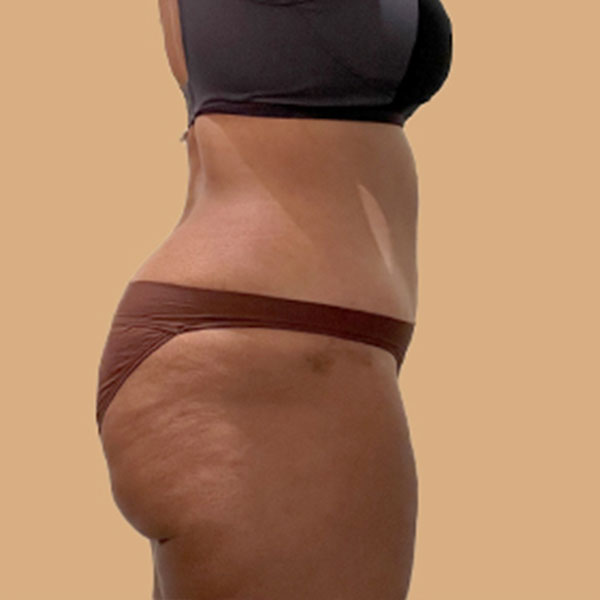 Liposuction Lower Back 07