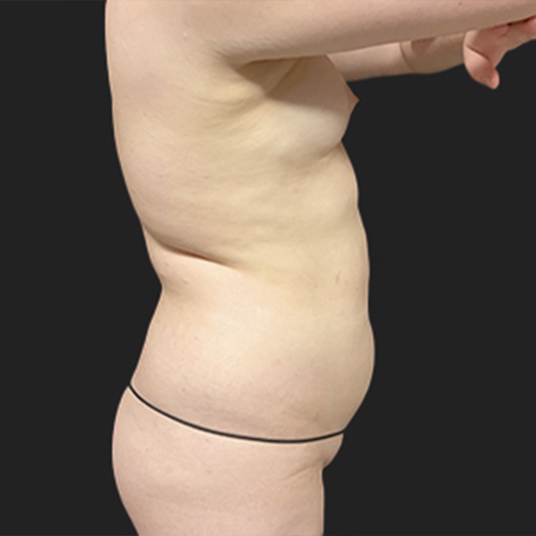Liposuction Lower Back 09