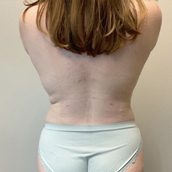 Liposuction Lower Back 11