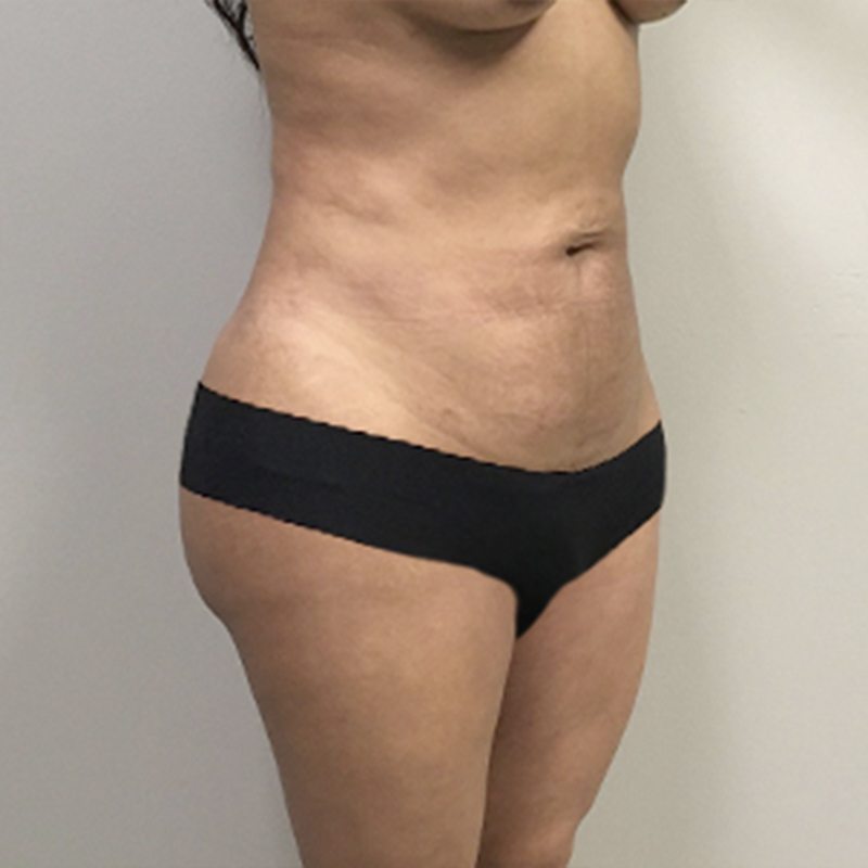Liposuction Lower Back 09