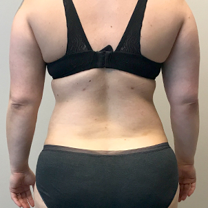 Liposuction Upper Back 06