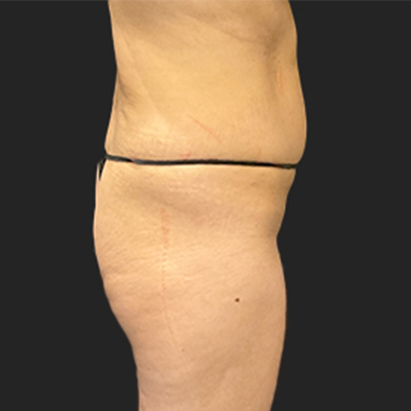 Liposuction Waist 03