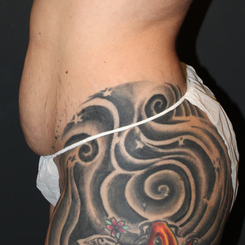 Liposuction Waist 01