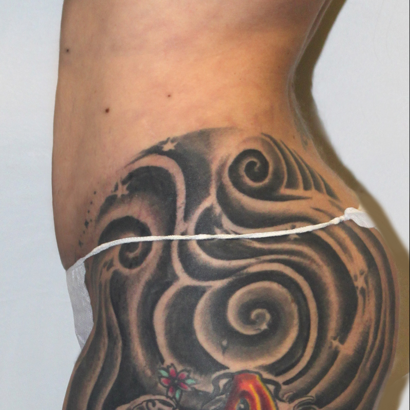 Liposuction Waist 05